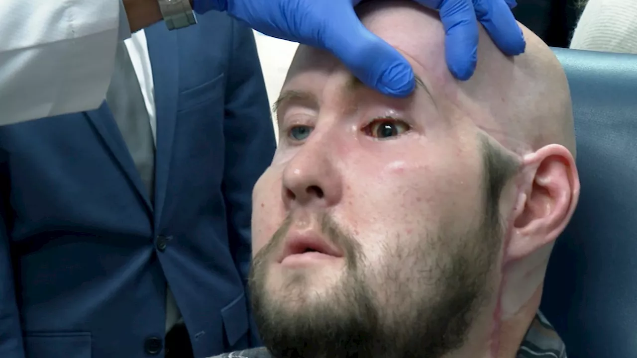 Man burned from the inside out in 7,200-volt electrocution gets world’s first eye transplant...