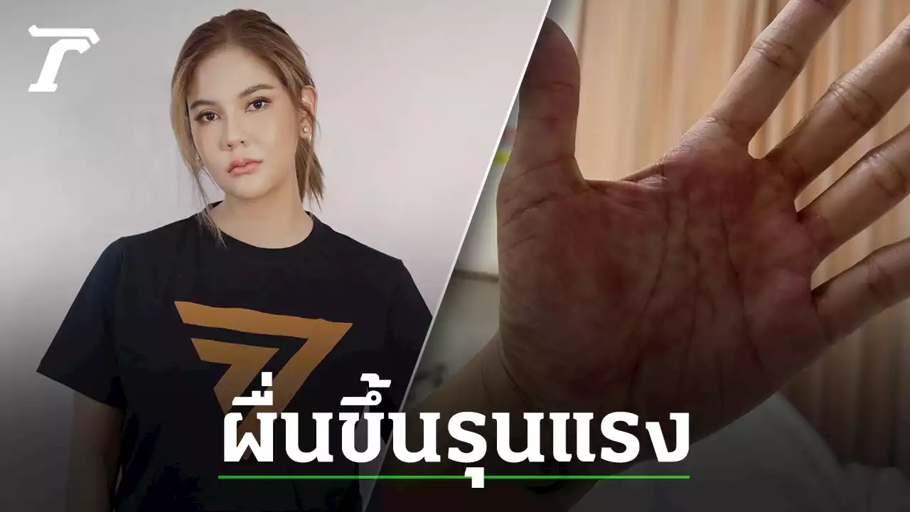 หมิว สิริลภัส แอดมิต รพ. หลังมีอาการผื่นขึ้นรุนแรง ไม่สามารถเดินได้