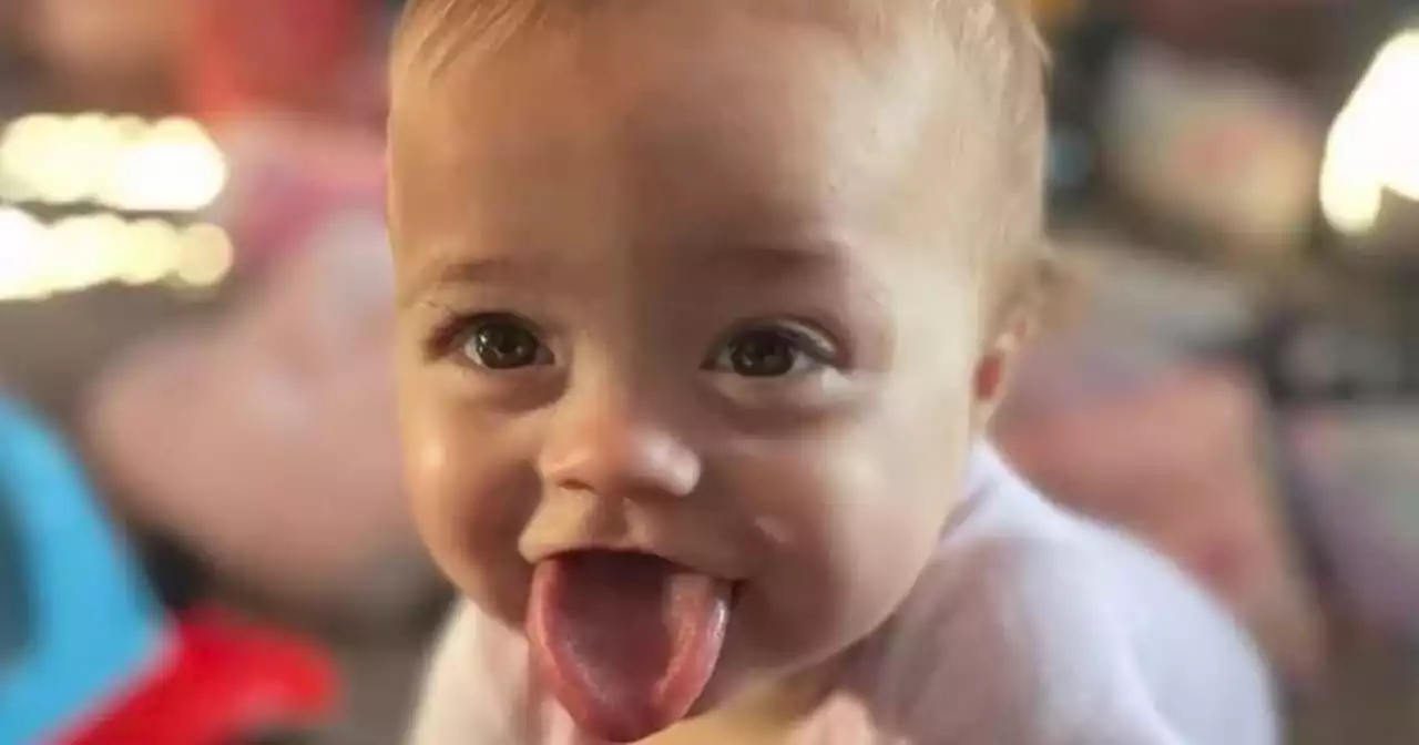 Brave baby girl, 1, born with tongue too big for her mouth