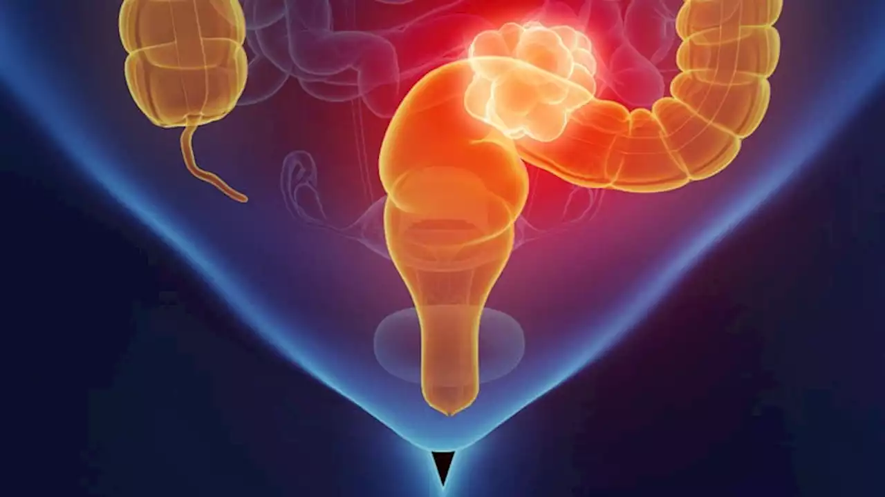 Long-Course RT Better at Organ-Sparing in Rectal Cancer