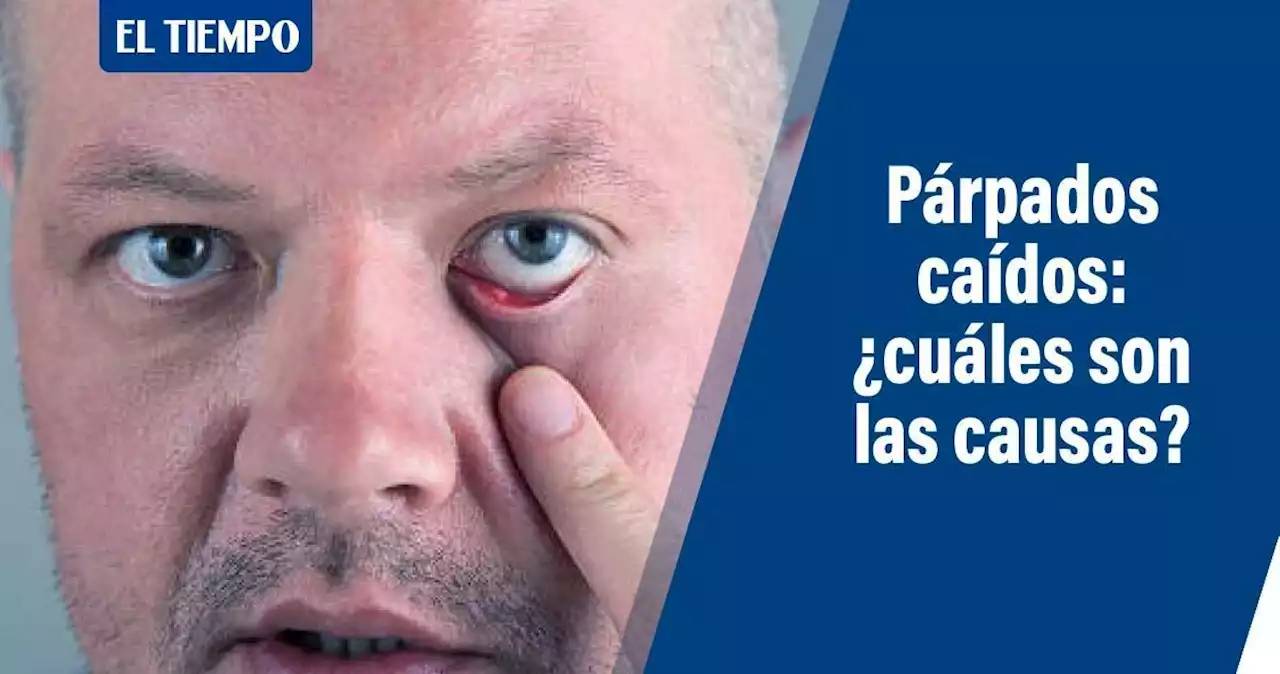 ¿Qué son los ojos caídos y cuáles son sus principales causas?