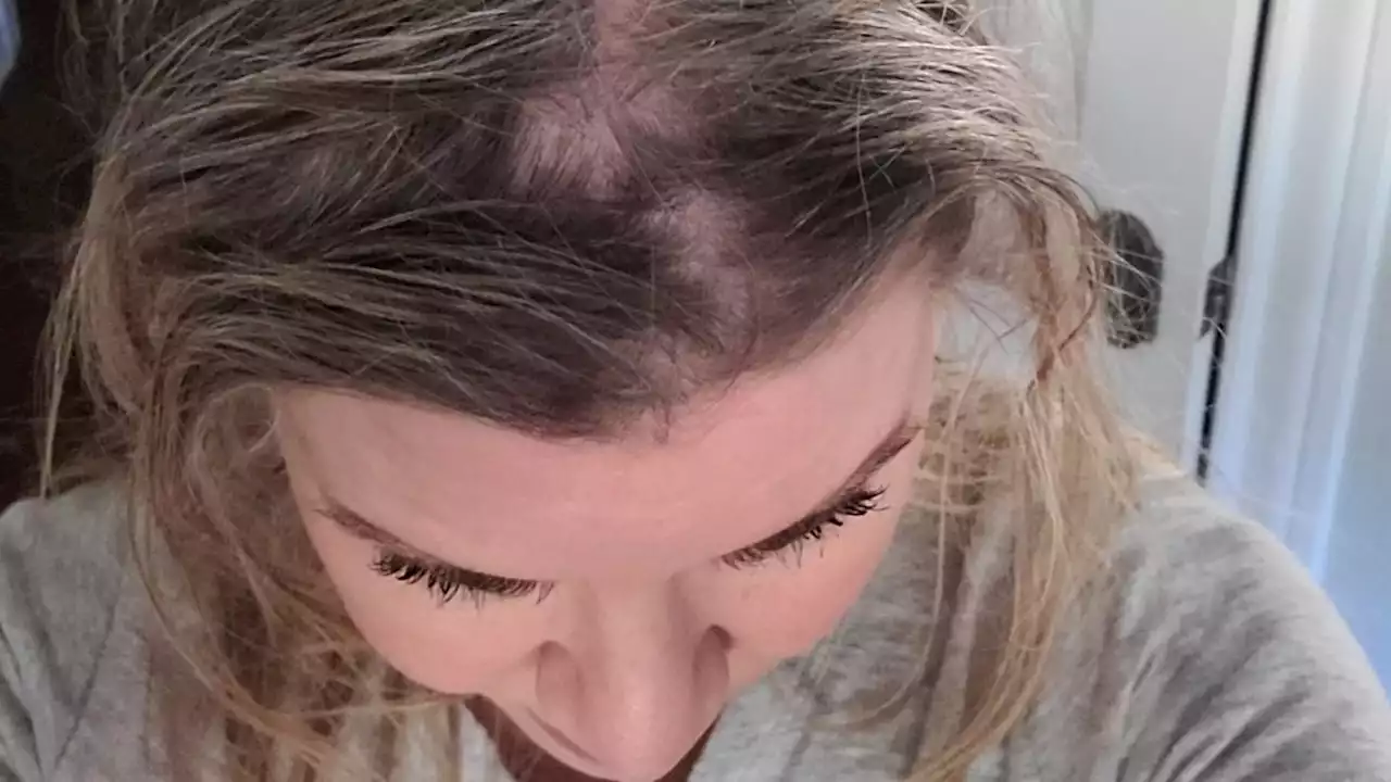 Women sue Olaplex hair-care company, claiming hair loss, bald spots, skin conditions