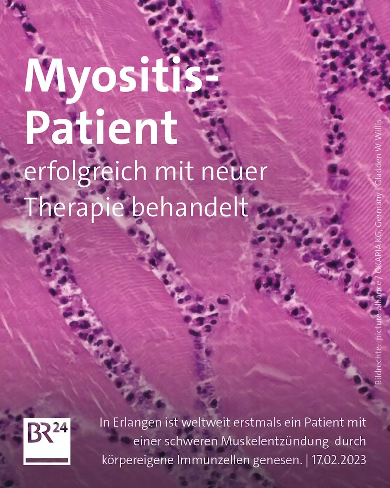 Erlangen: Erstmals Mann von schwerer Autoimmunerkrankung genesen