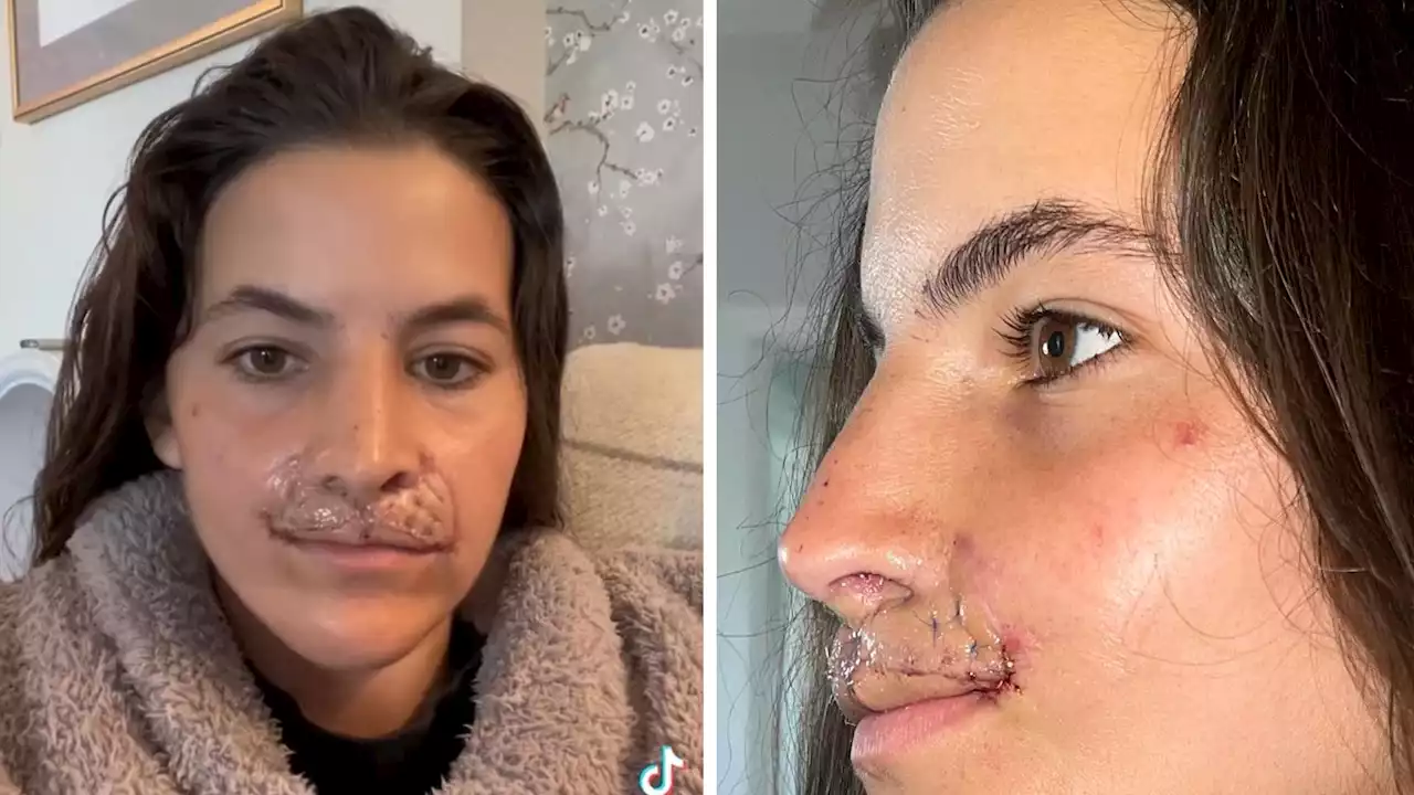 Brooklinn Khoury Shows Off Results of Latest Lip Reconstruction Surgery, Details Procedure