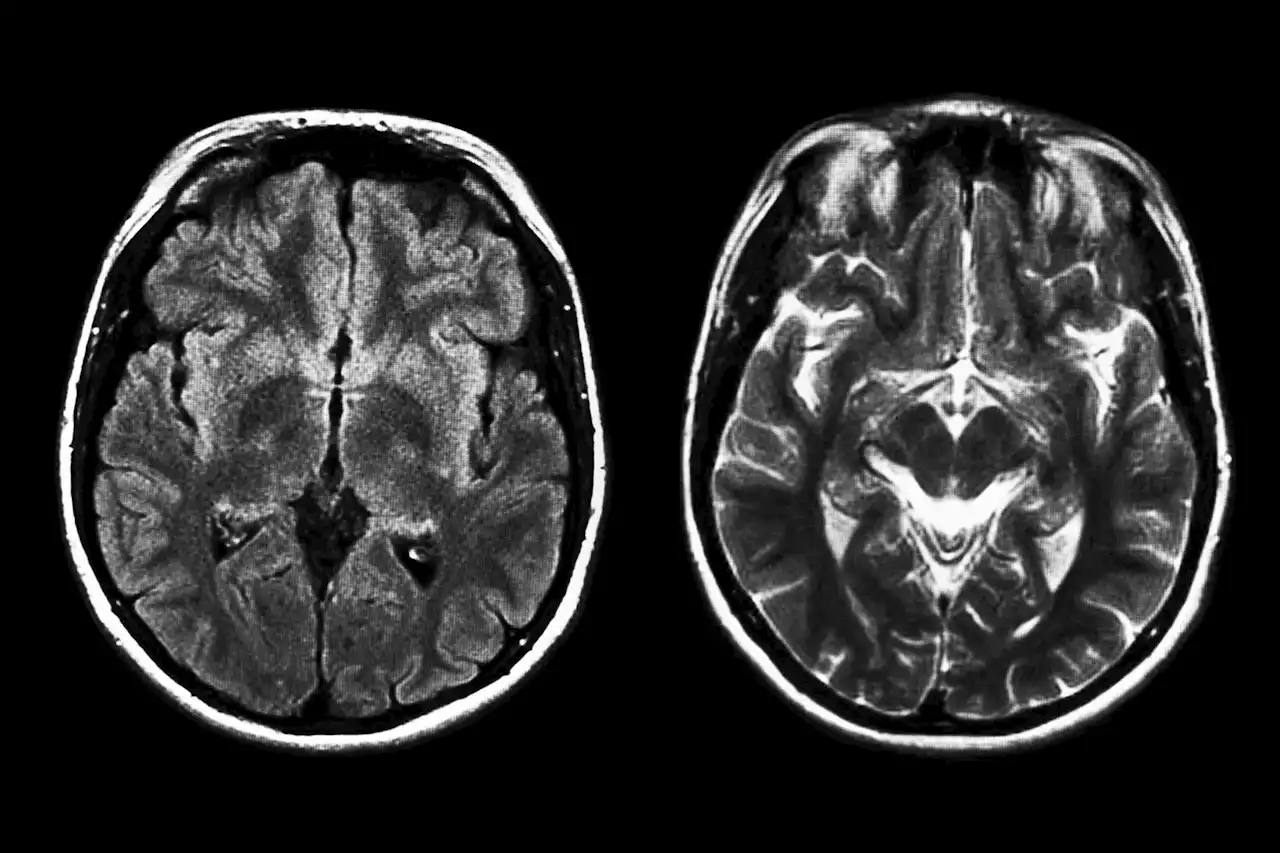 Cocaine Addiction Makes the Brain Age Faster – Could Be Caused by Inflammation or Cell Death