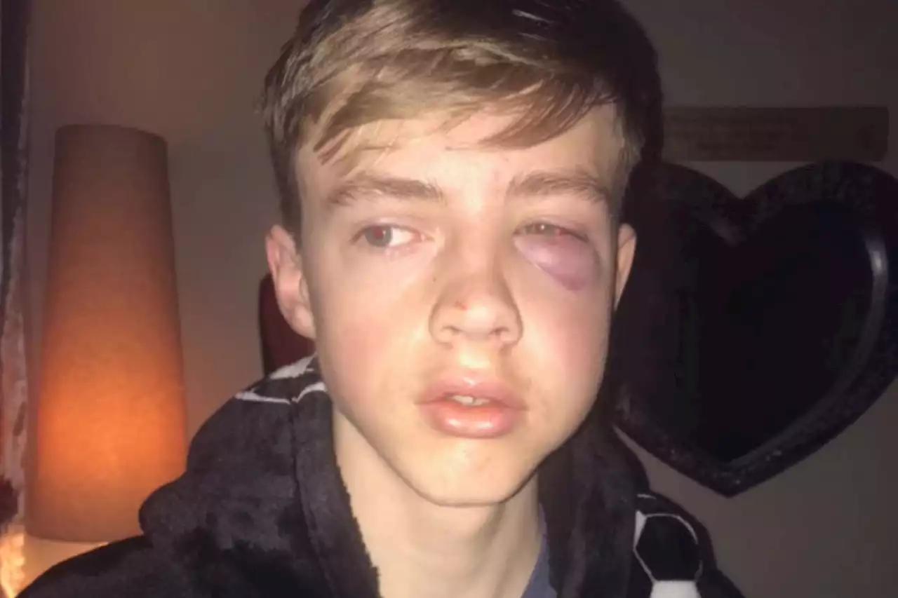 Teen footballer’s battered face after thug from opposing team ‘punched him’