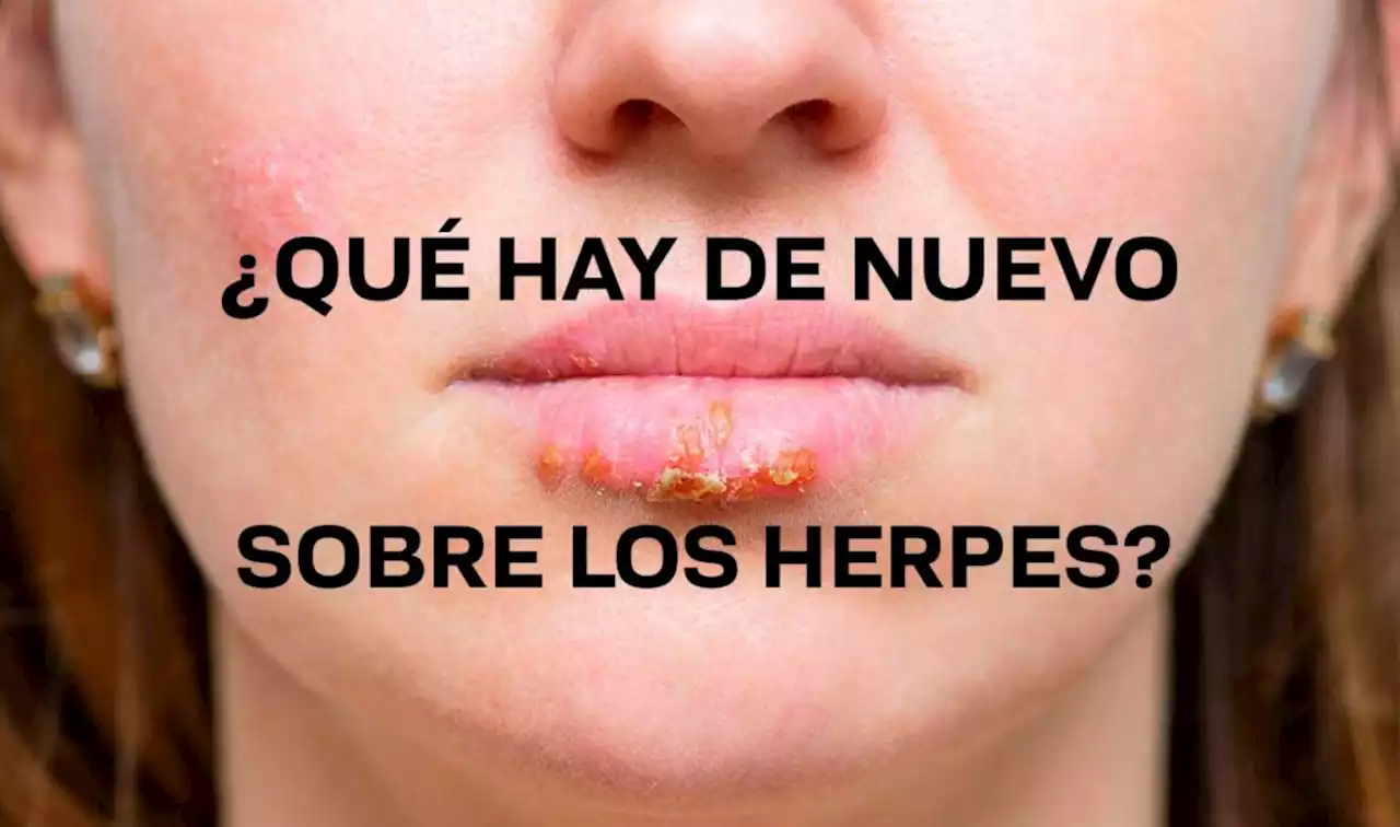 70% de la población mundial infectada por herpes simple 1 | UNAM Global