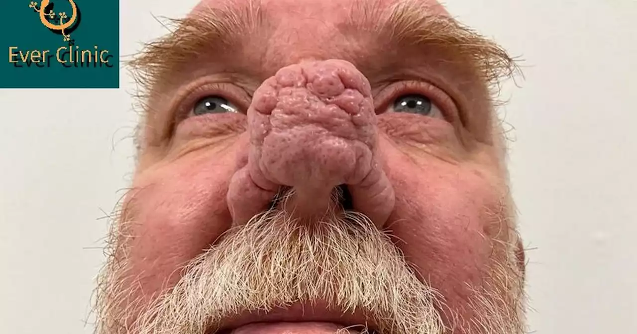 Man with deformity who nicknamed nose John Merrick can 'rejoin human race'