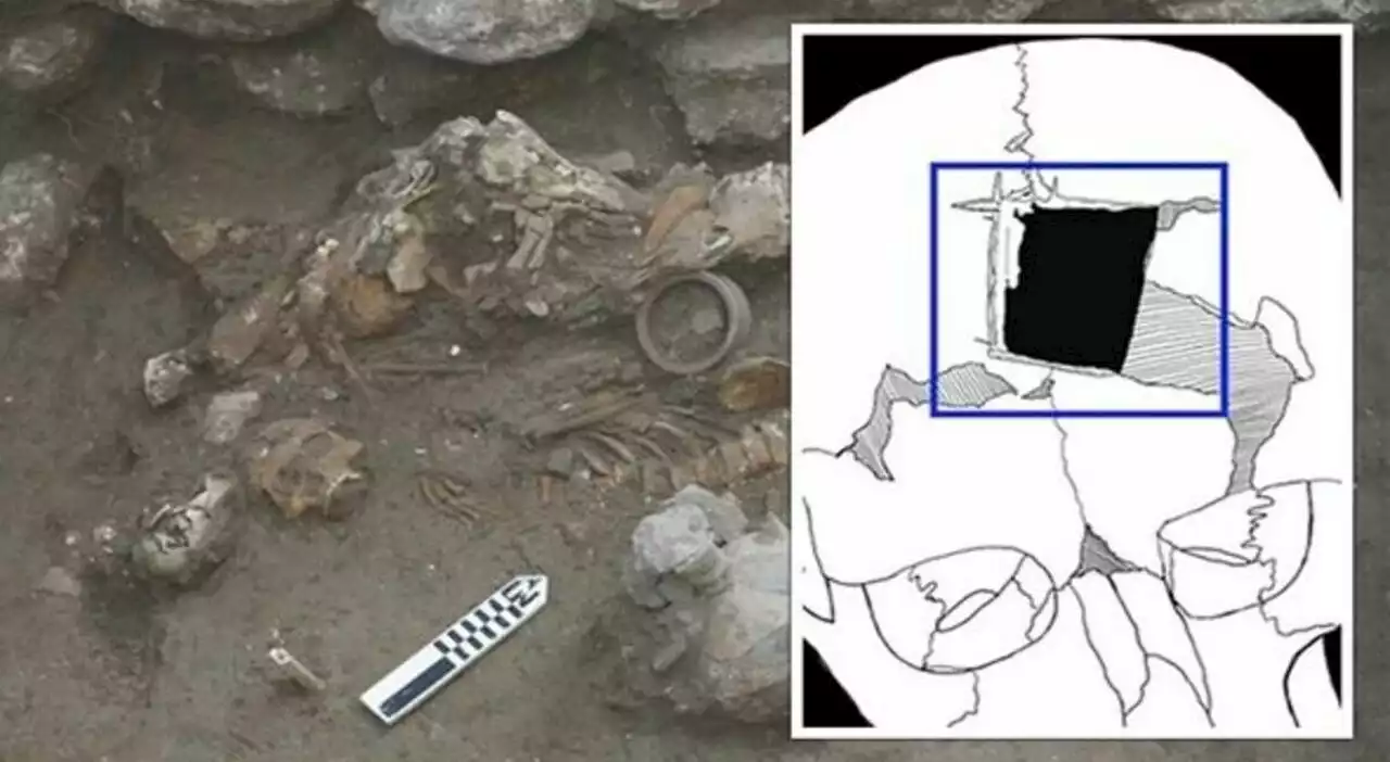 Operazione al cranio risalente all'età del bronzo: la scoperta durante uno scavo archeologico in Israele