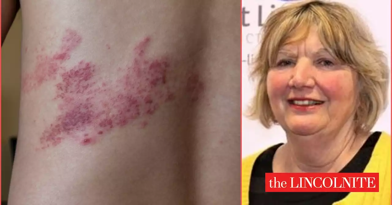 Councillor’s shingles warning after debilitating nerve pain