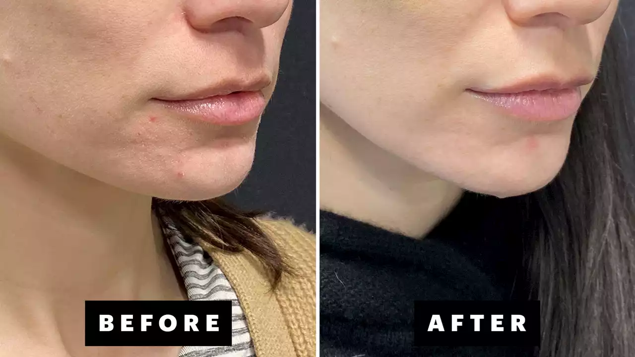 AviClear Is Helping My Hormonal Acne — With Before and Afters