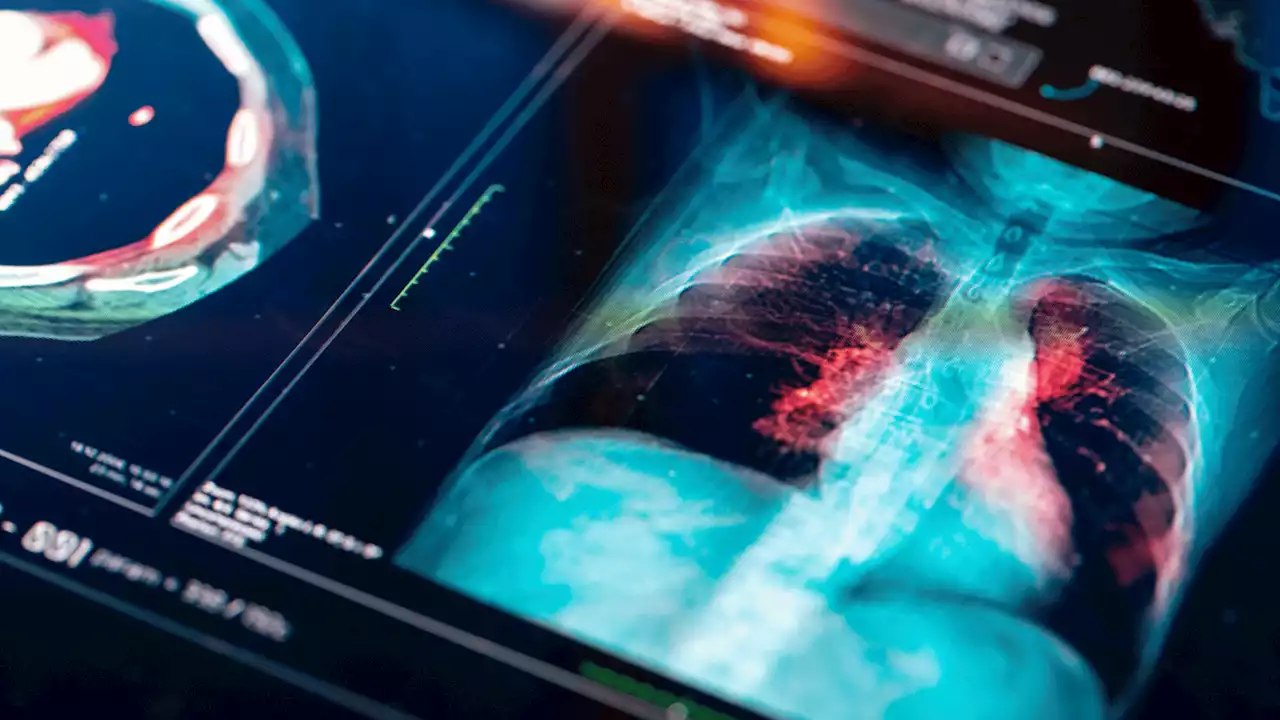 Harnessing the power of AI to learn more about deadly cancers