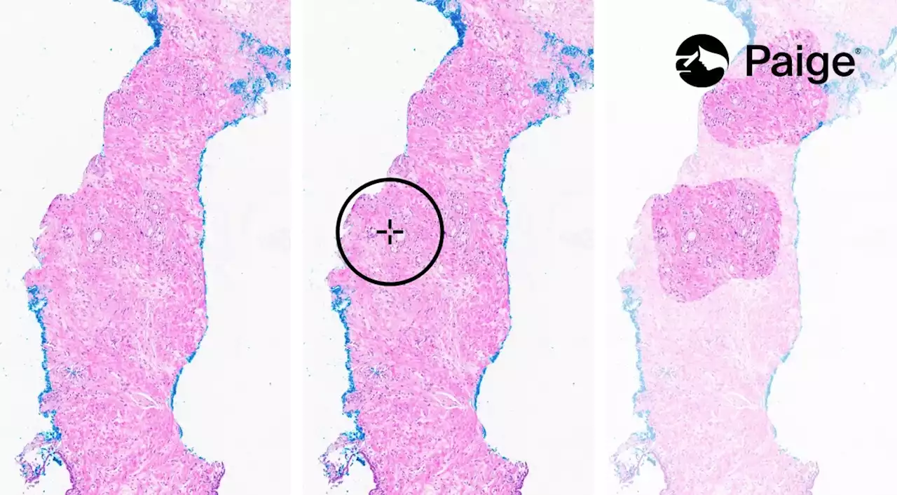 World Cancer Day 2023: Understanding the patient perspective regarding the use of AI in prostate cancer - On Medicine