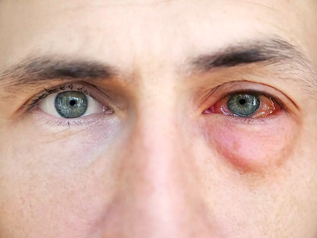 Study reports two cases of ocular MPox in HIV-infected patients