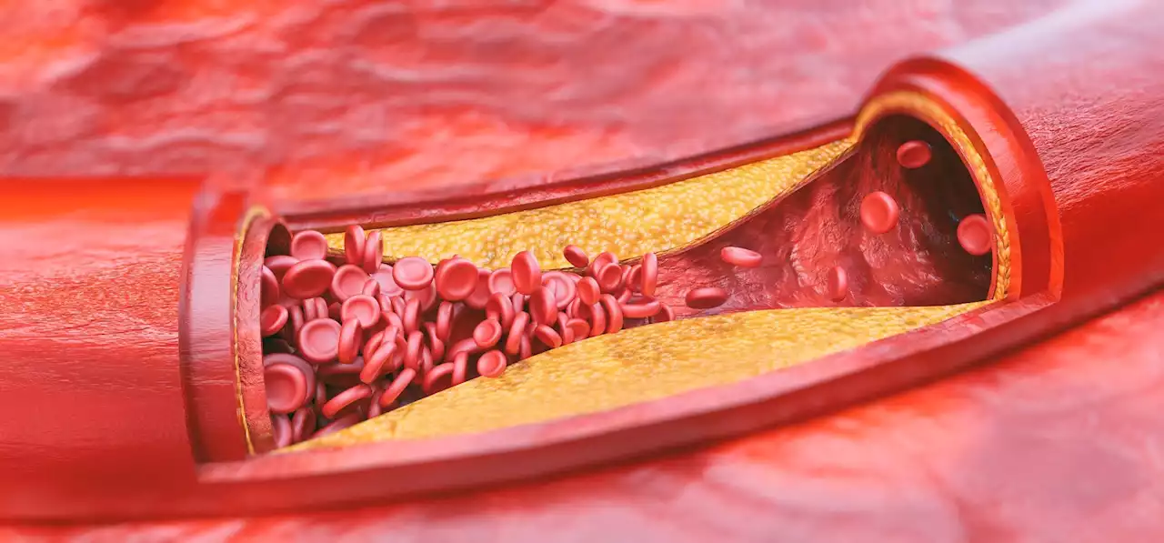 Investigating the association between lipid profile and coronary heart disease by race