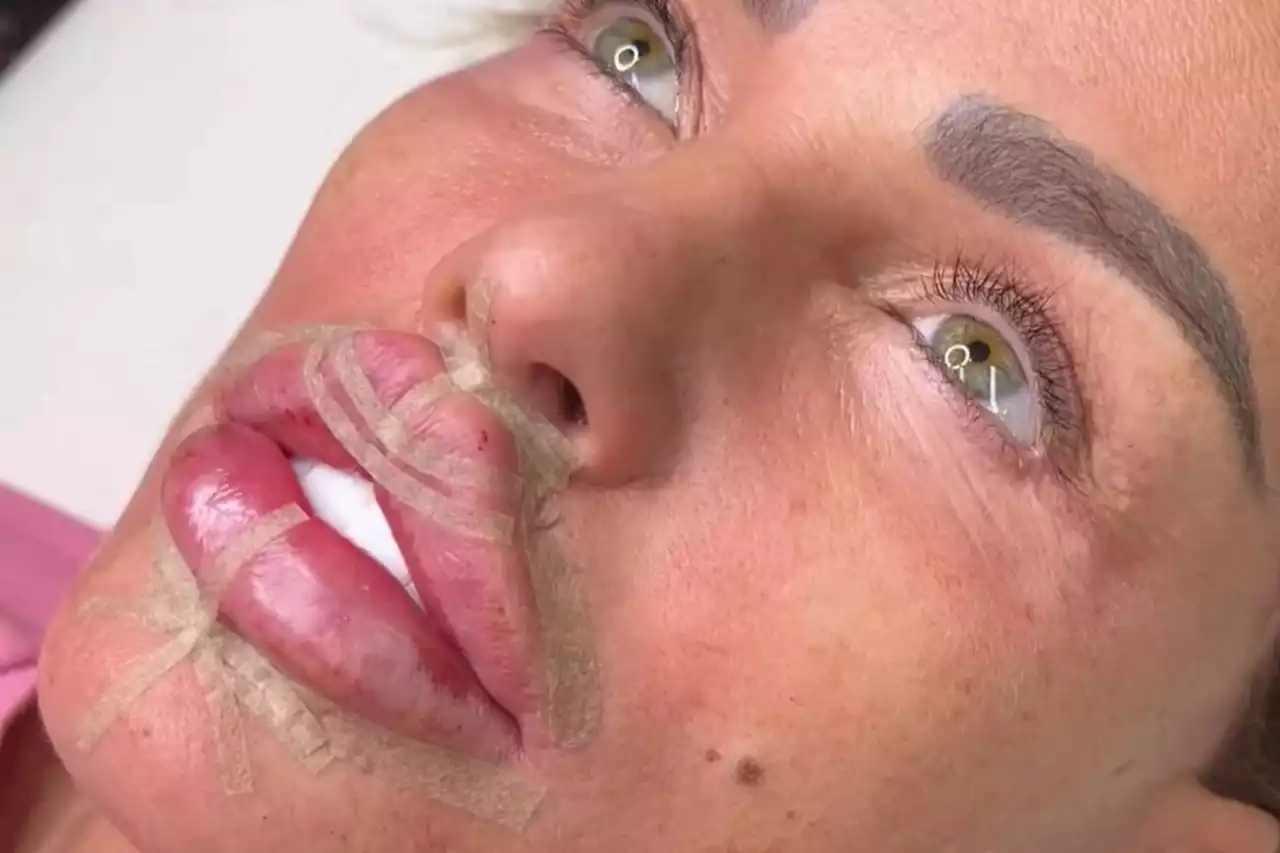 Katie Price reveals huge new lips after getting plumped-up pout and Botox