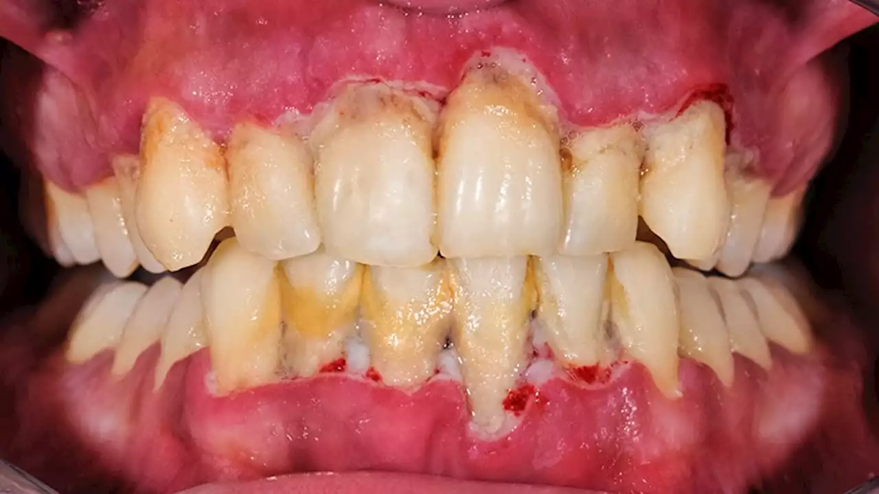 Bacteremia, Antibodies Link Periodontal Disease and RA