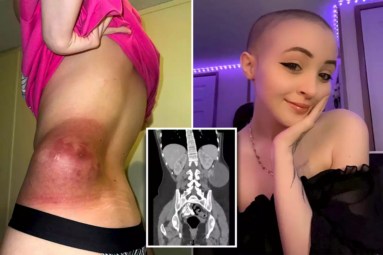 I make $80k selling nudes to pay for cancer treatment — men love bald look