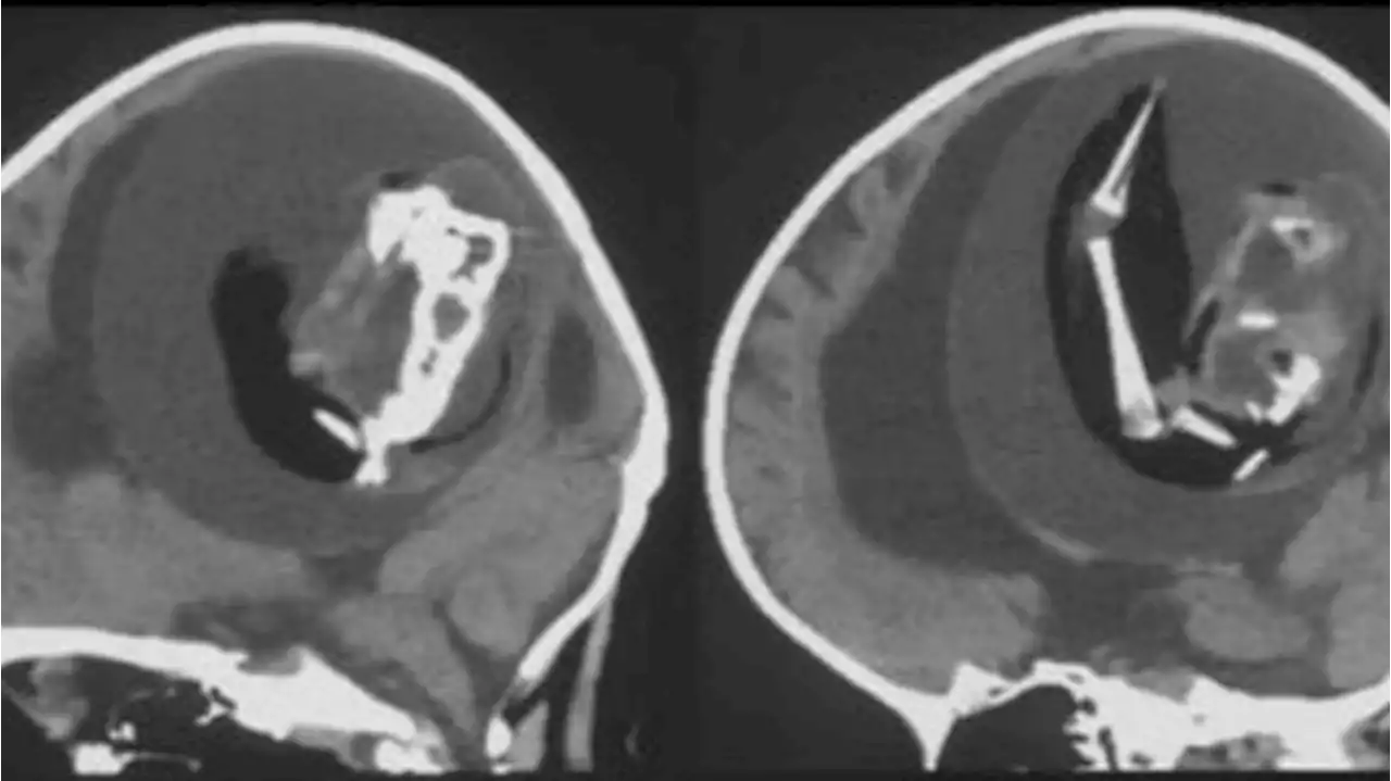 갓난아기 머리 커 열어보니…두개골서 쌍둥이 태아 자랐다 | 중앙일보