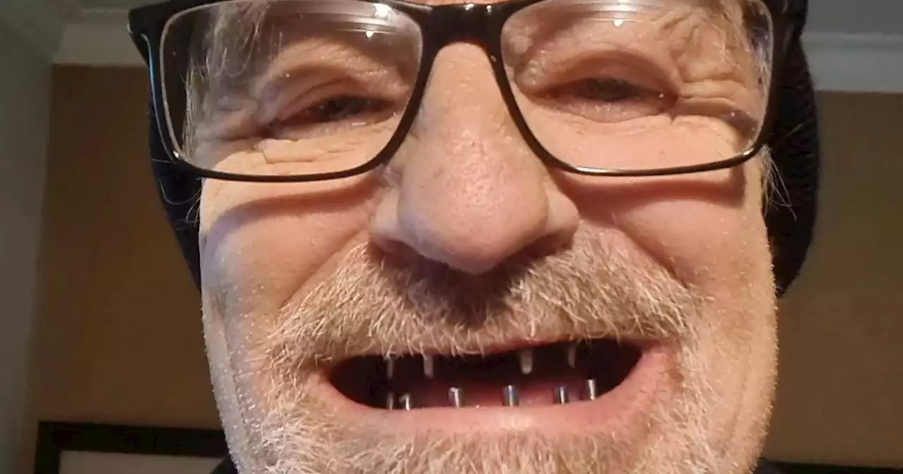 Grandad looks '10 years younger' after 'smoker' teeth pulled out in Turkey