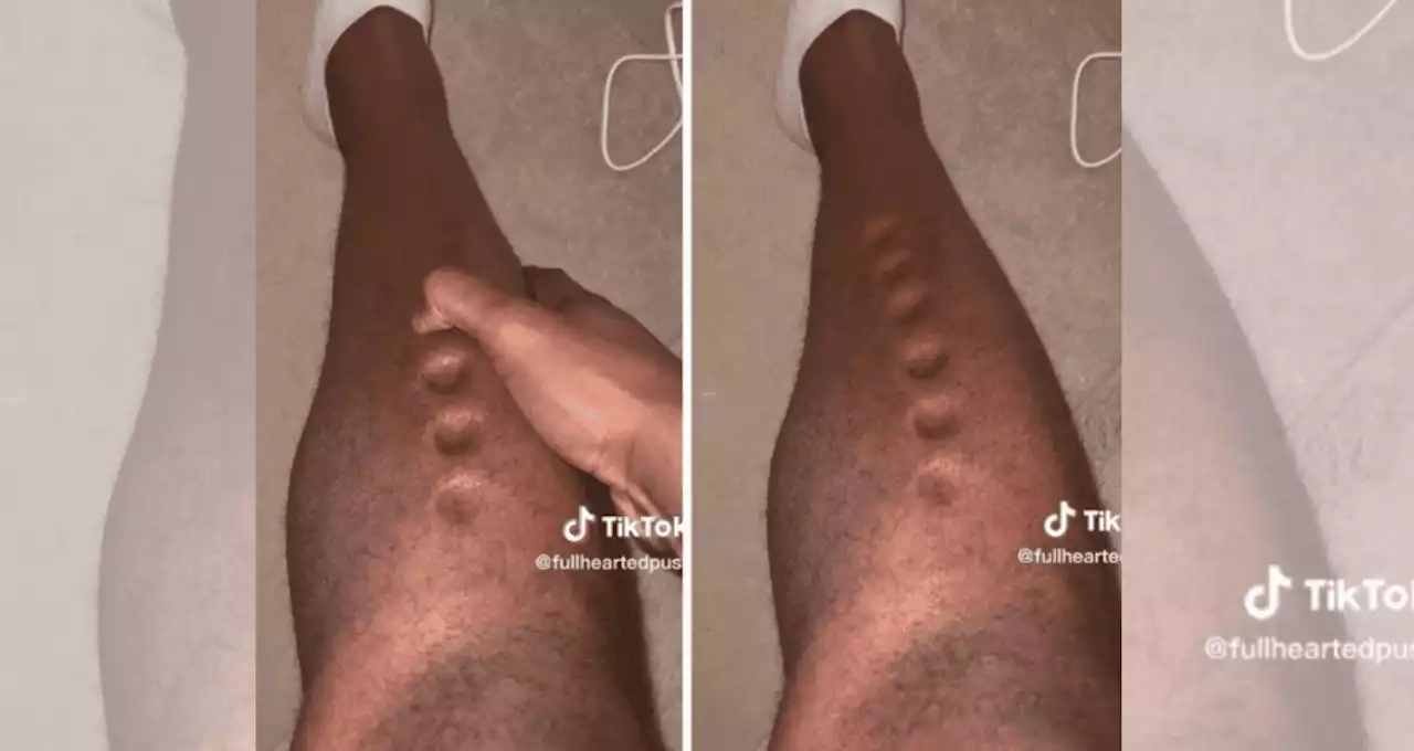 'Piel de plastilina': la patología que sufre un atleta olímpico y es viral en redes