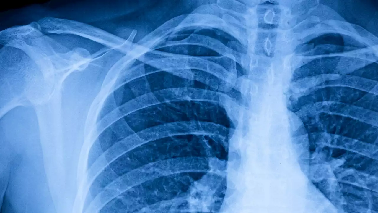 This AI tool is great at spotting abnormalities in chest X-rays