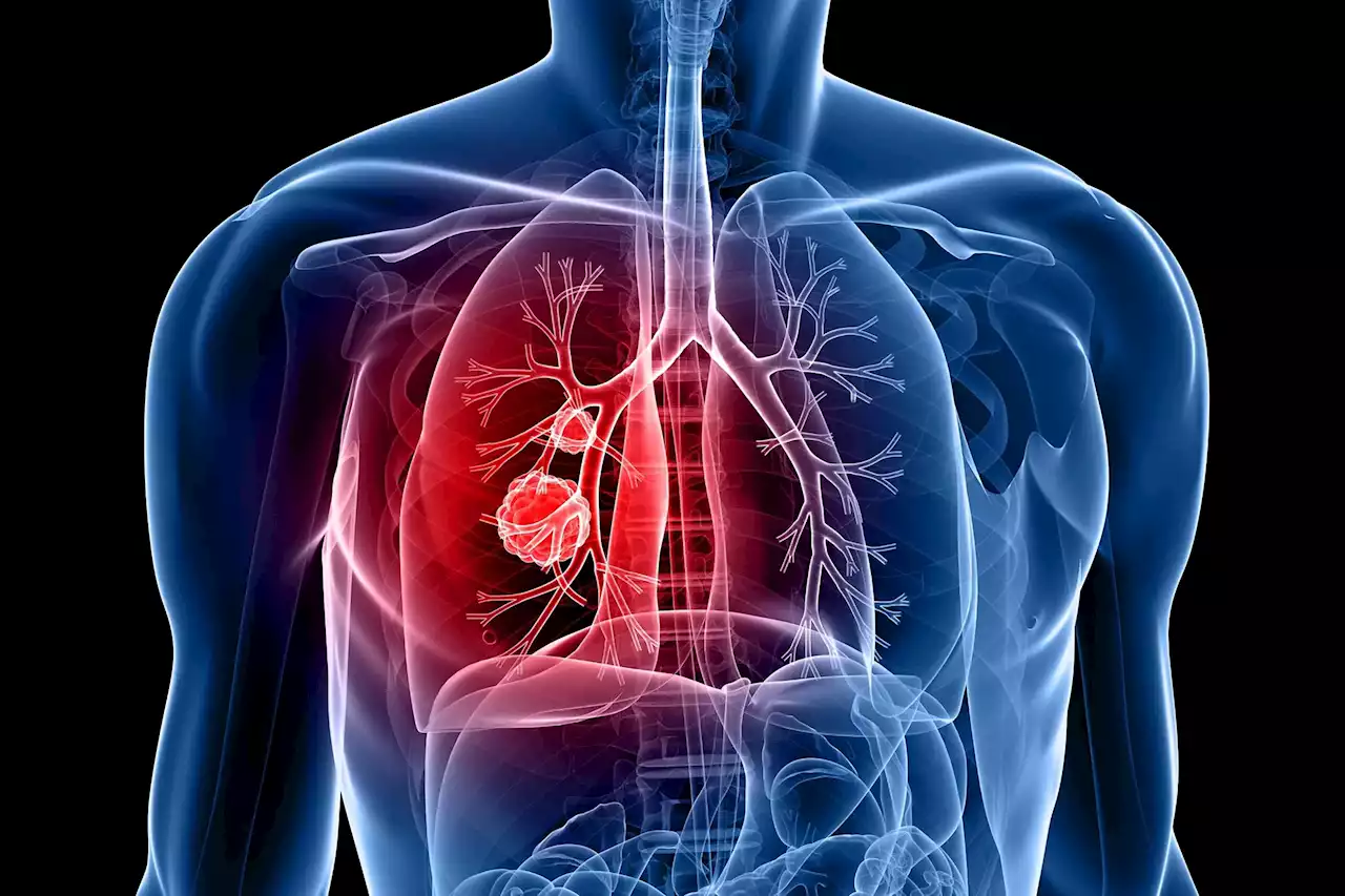 A Dangerous Connection: Depression Linked to Deadly Inflammation in Lung Cancer Patients