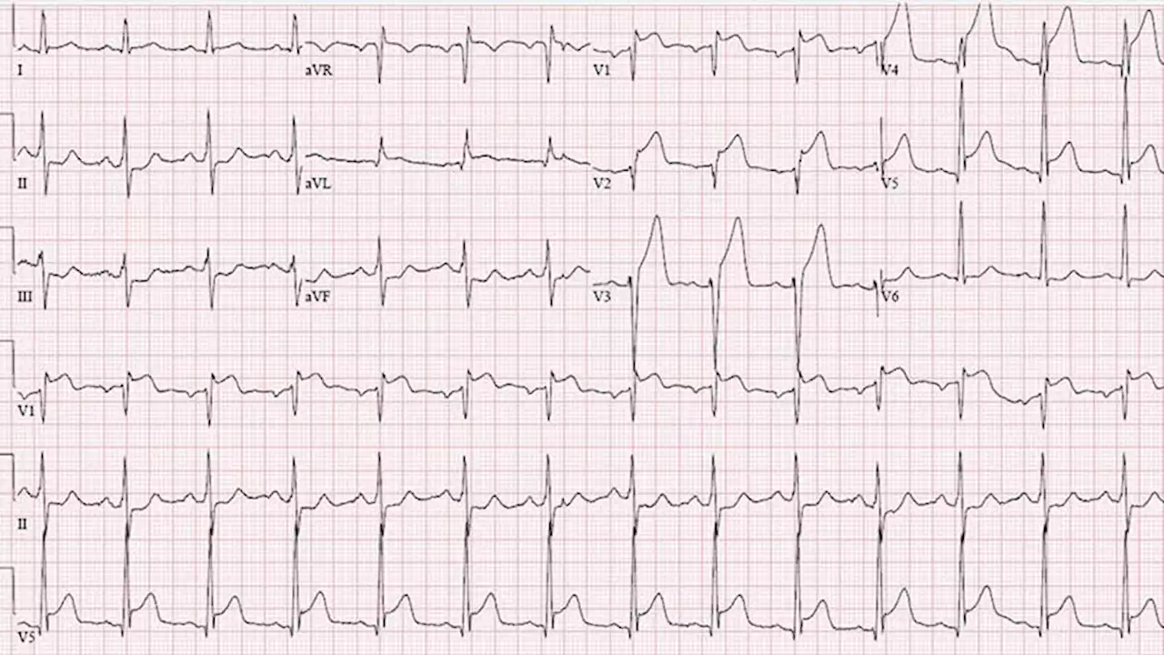 Half-dose TNK for STEMI Without Timely PCI: STREAM-2