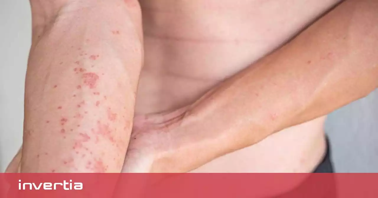 Un nuevo fármaco para dermatitis atópica aterriza en España para pacientes que no pueden controlar síntomas