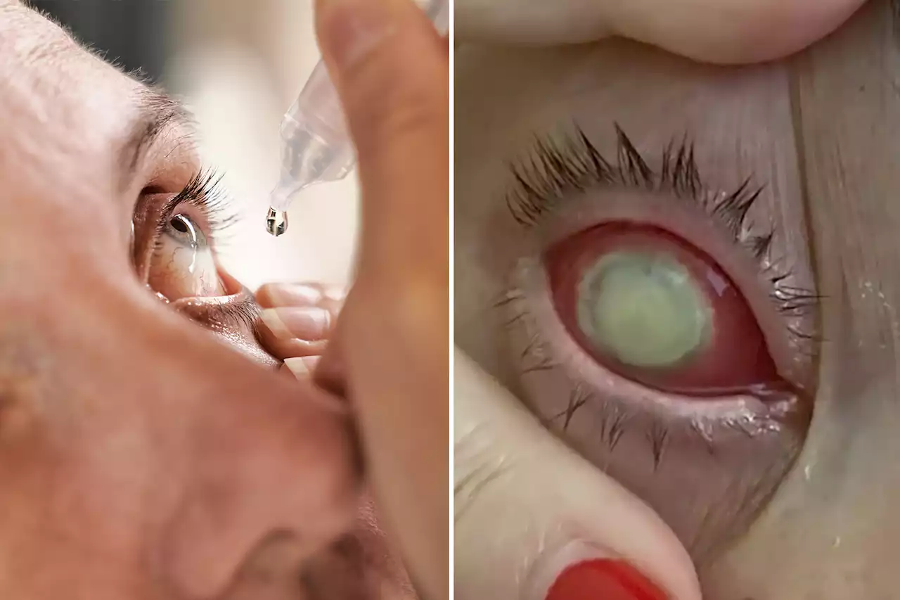 Eyedrops kill 1, force others to have eyes removed due to drug-resistant bacteria: CDC alert