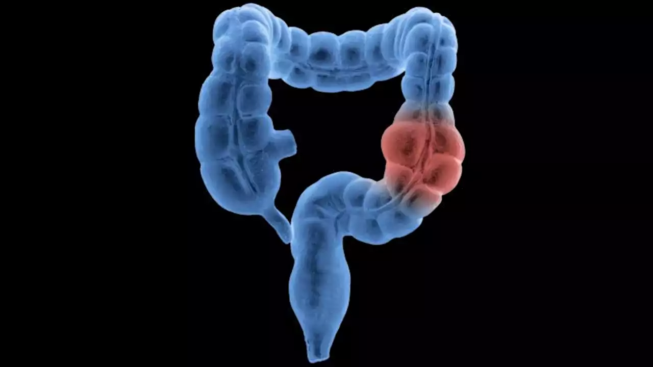 Report shows 'troubling' rise in colorectal cancer among US adults younger than 55 | CNN