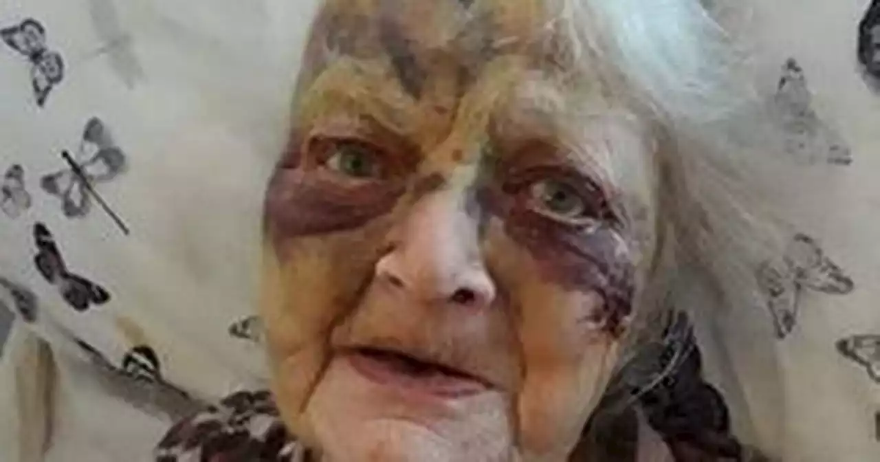 Family searching for answers after gran suffered facial injuries at care home