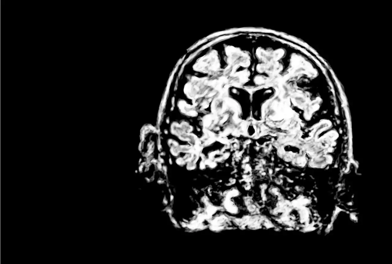 Research investigates roles of neurotrophic factors on cognition in Alzheimer's patients carrying APOE ε4