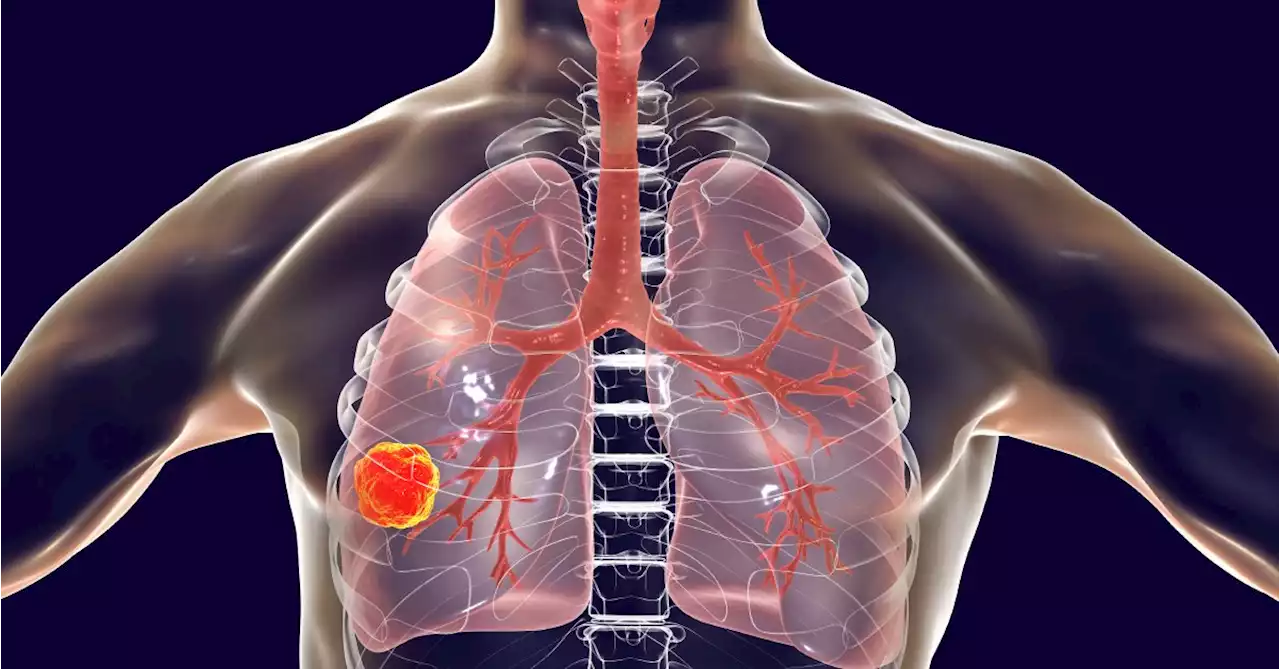 What No One Tells You About Lung Cancer