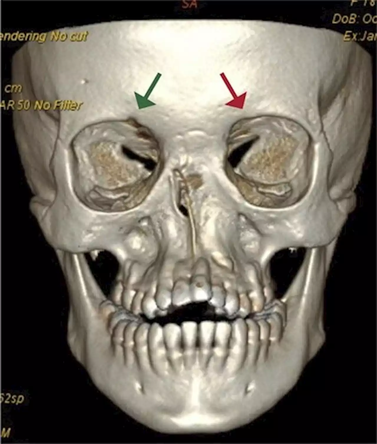 Innovative surgical technique creates a nose for patients with 'extremely rare' genetic syndrome