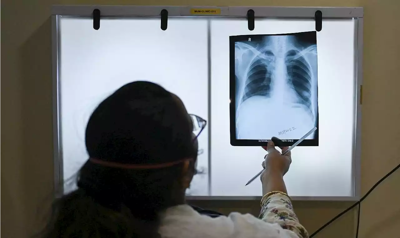 At least 447,696 actual tuberculosis cases reported in 2022 –DOH