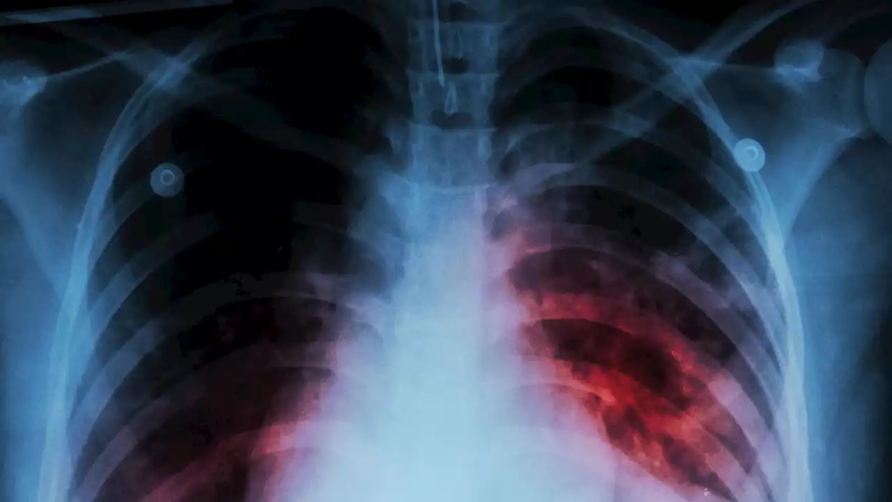 Commissioner decries rise in TB cases in Plateau | The Guardian Nigeria News - Nigeria and World News