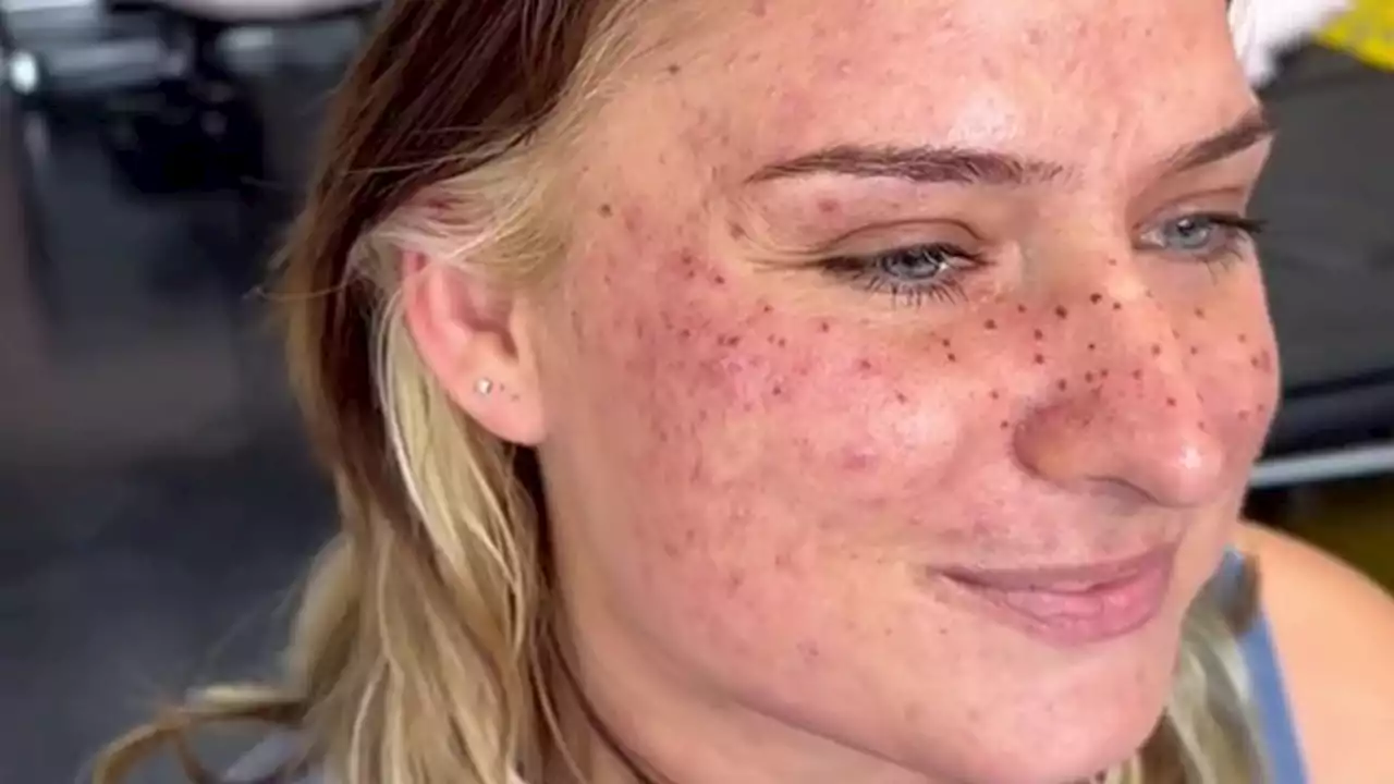 Trolls saw woman's new 'night sky' face inkings look like measles