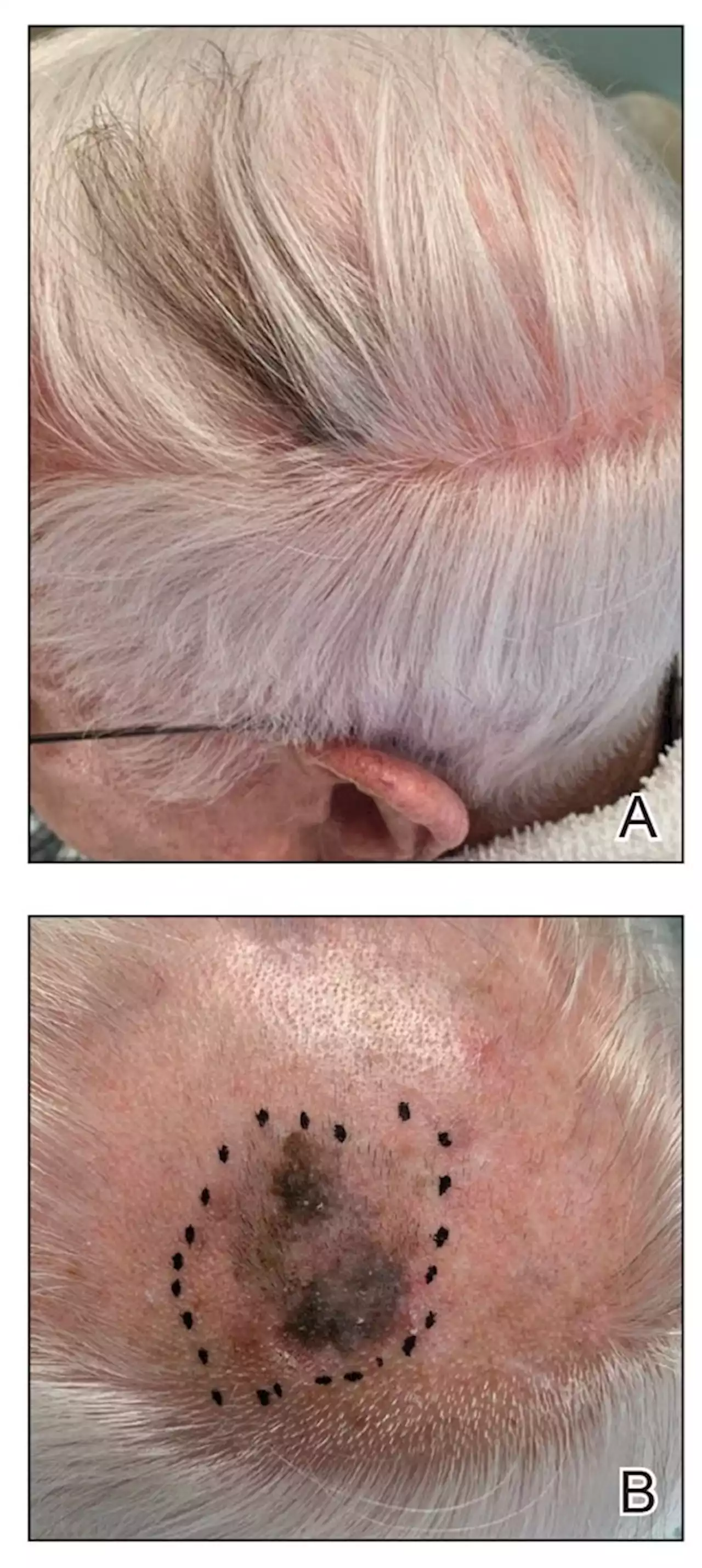 Hair Repigmentation as a Melanoma Warning Sign