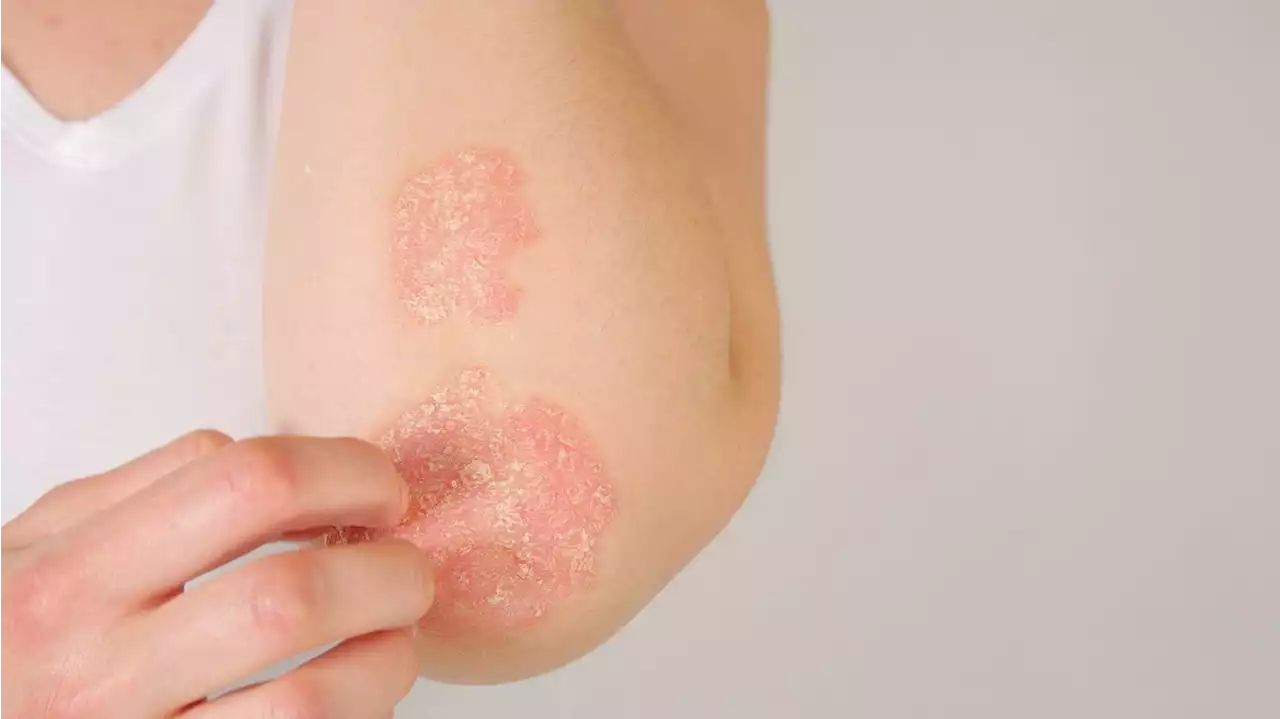 Psoriasis: What this doctor wants you to know