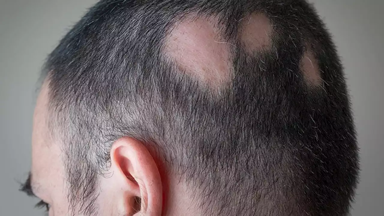 New JAK Inhibitor Study Data Confirm Benefit in Alopecia Areata