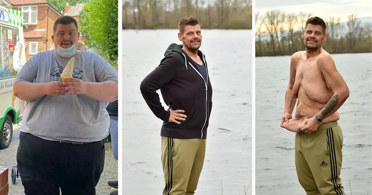 'I lost 20 stone but the NHS wont pay to remove my excess skin'