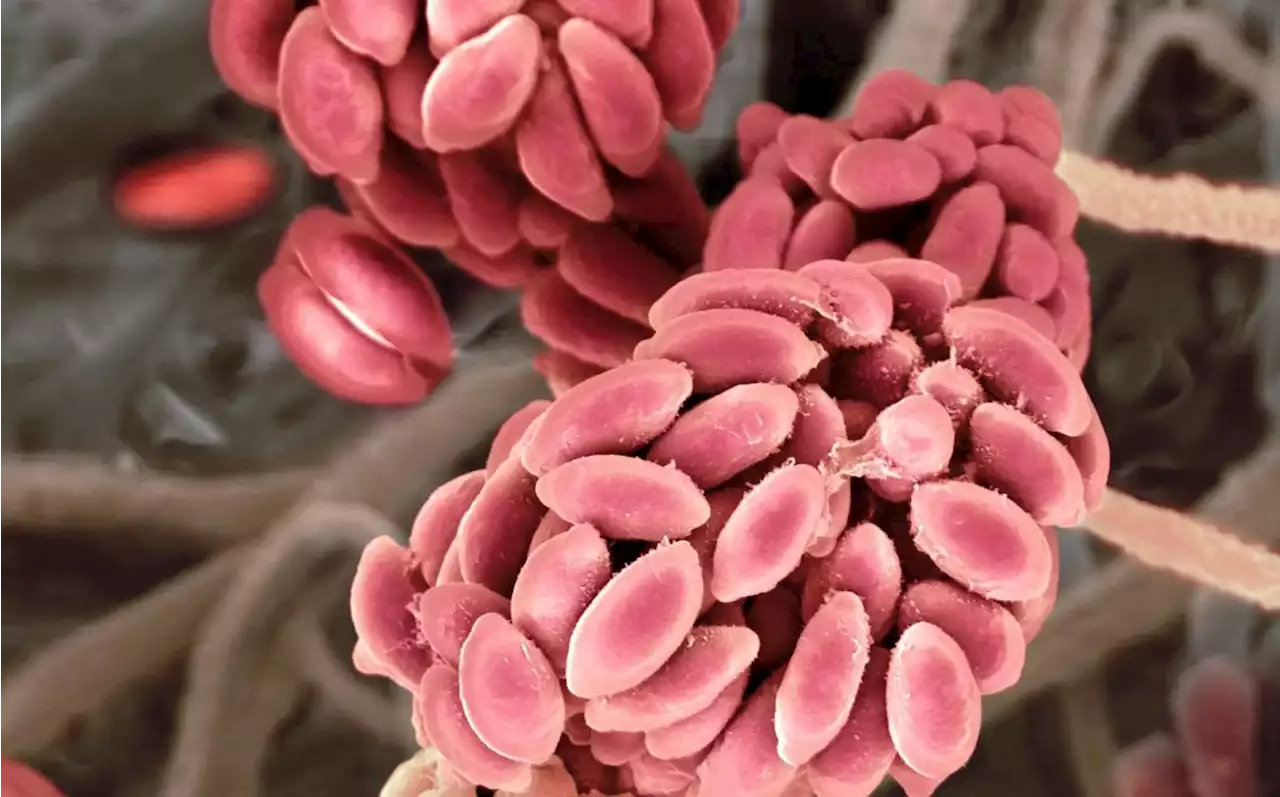 Indian man is world’s first person to contract fungal infection from a plant