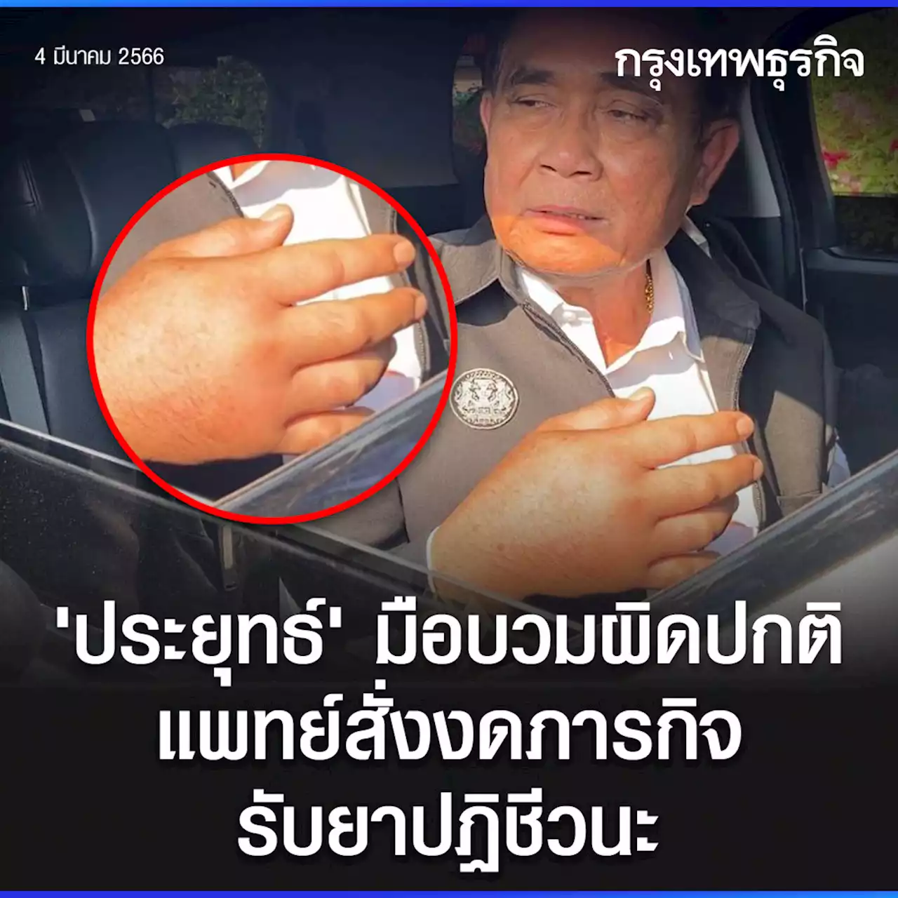 “นายกฯ” ยังไม่ออกจาก รพ. หลังแพทย์พบมือขวาบวมผิดปกติ สั่งงดภารกิจ