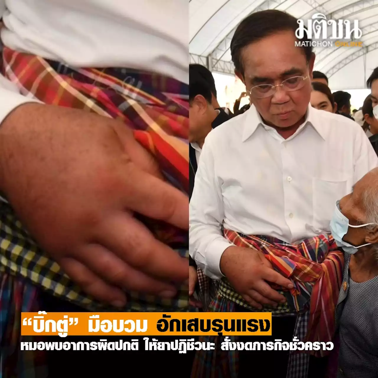 เผยอาการมือบวม “บิ๊กตู่” แพทย์พบอาการผิดปกติ รับการรักษา-สั่งงดภารกิจชั่วคราว