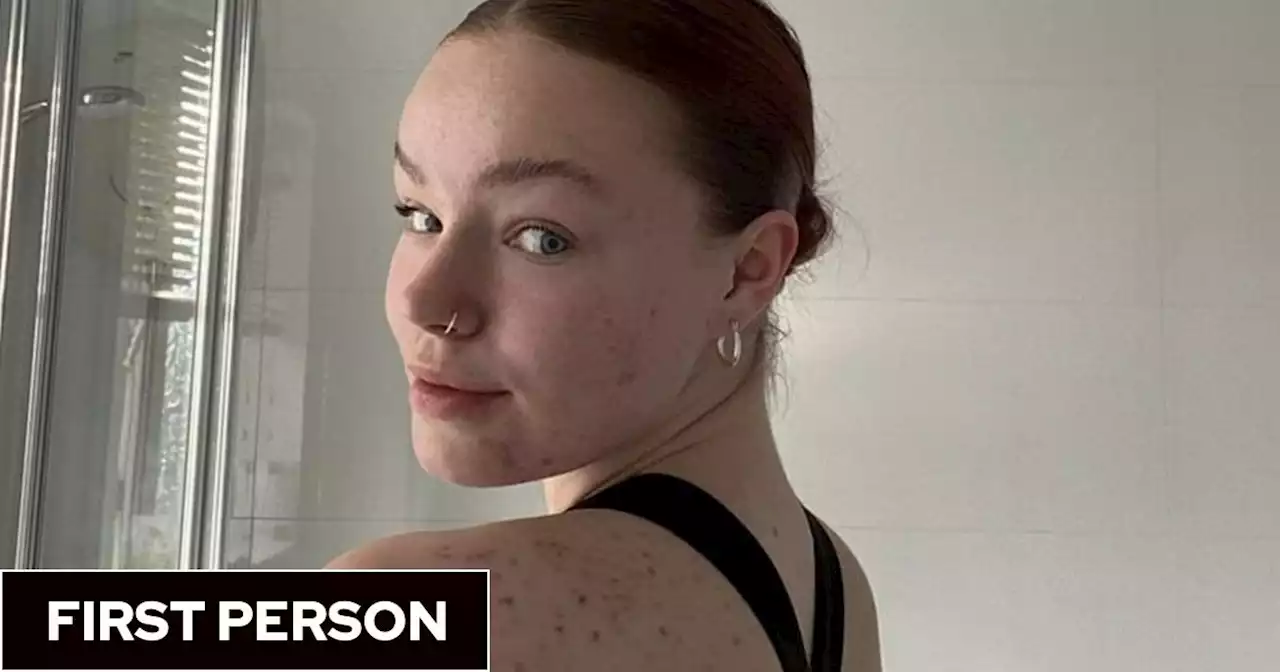 Living with acne: ‘I had to wake up every day and not touch my face because it hurt so much’