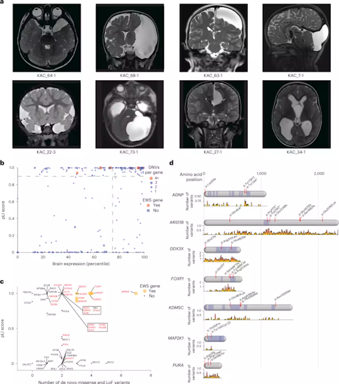 Multiomic analyses implicate a neurodevelopmental program in the pathogenesis of cerebral arachnoid cysts - Nature Medicine