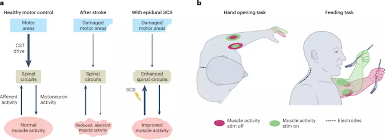 Facilitating limb movement after stroke - Nature Medicine