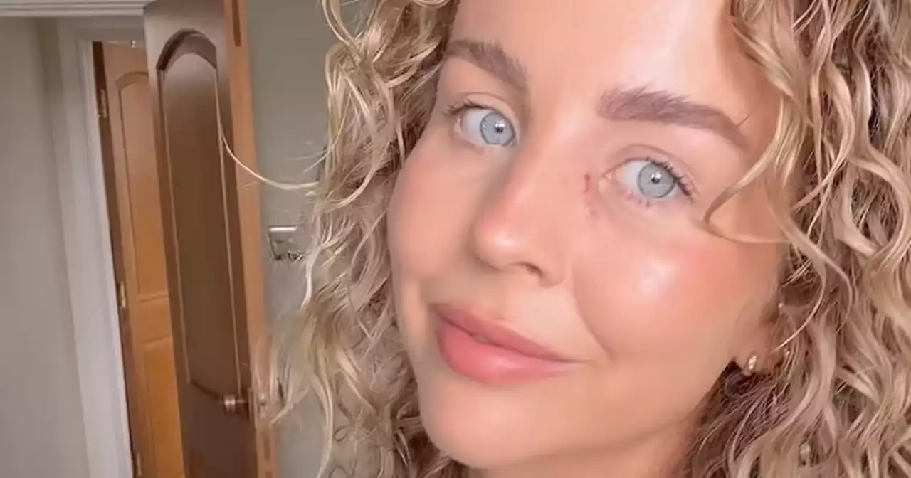 TOWIE star Lydia Bright has stitches removed after eye surgery