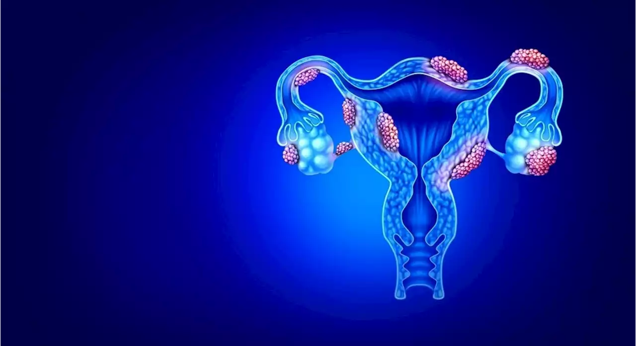 Recent Advances in the Treatment of Endometriosis